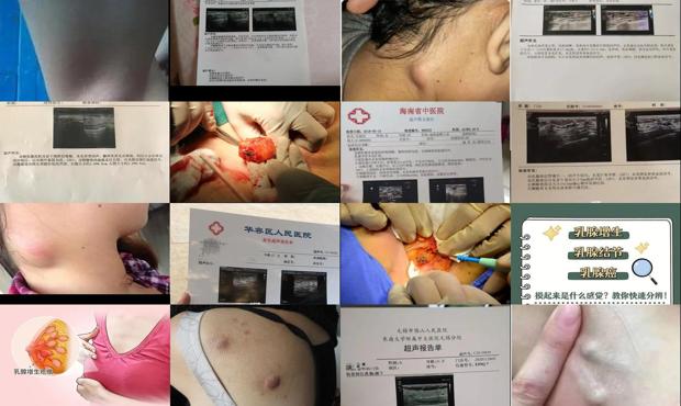 汕头乳腺增生淋巴结节