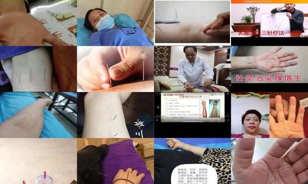 汕头乳腺增生针灸能治好吗