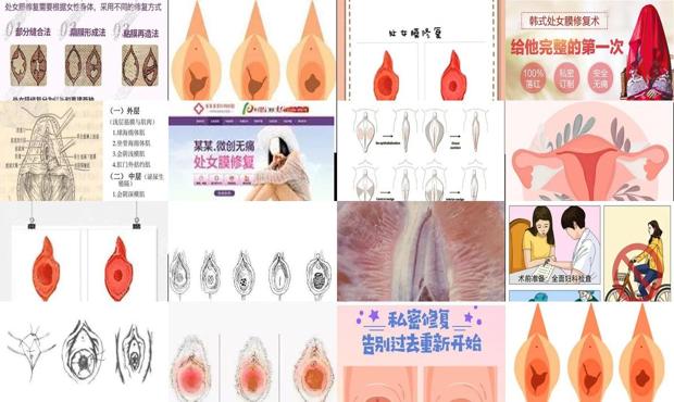 汕头哪里有修复处女膜