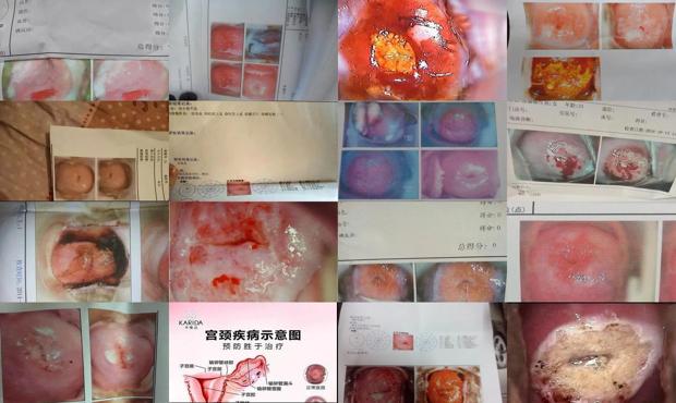 汕头宫颈糜烂