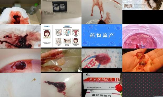 汕头早期药物流产
