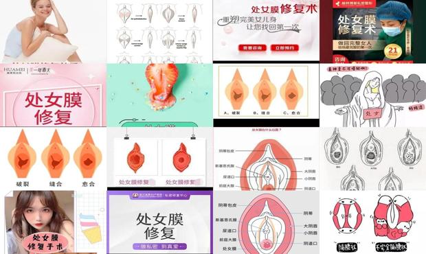 汕头处女怎么修复