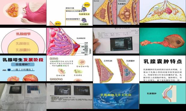 汕头乳腺*属于增生吗