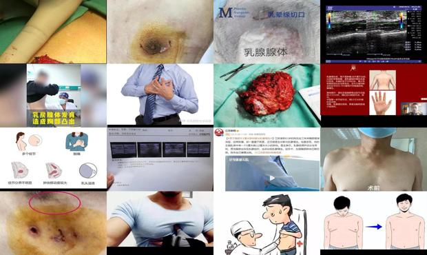 汕头男性乳腺增生