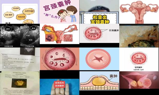 汕头宫颈*