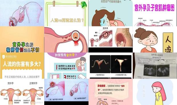 汕头宫外孕会意外流产吗