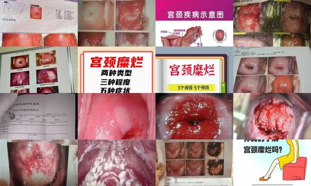 汕头宫颈糜烂的症状