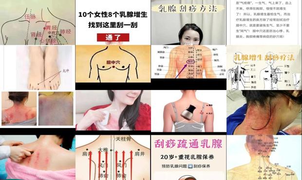 汕头哪里有刮痧能治乳腺增生吗