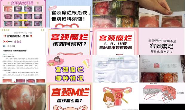 汕头宫颈糜烂怎么根治