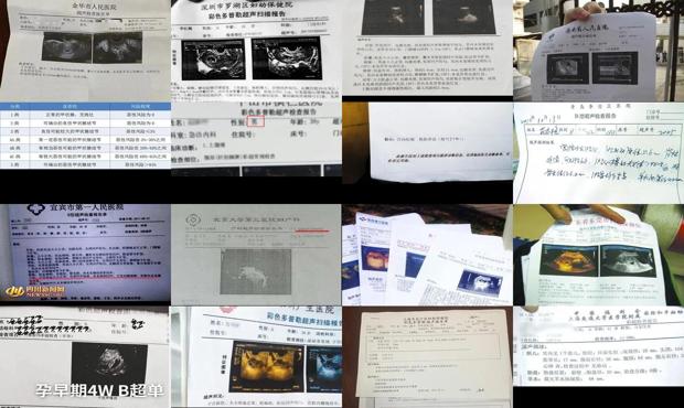 汕头b超检查报告单