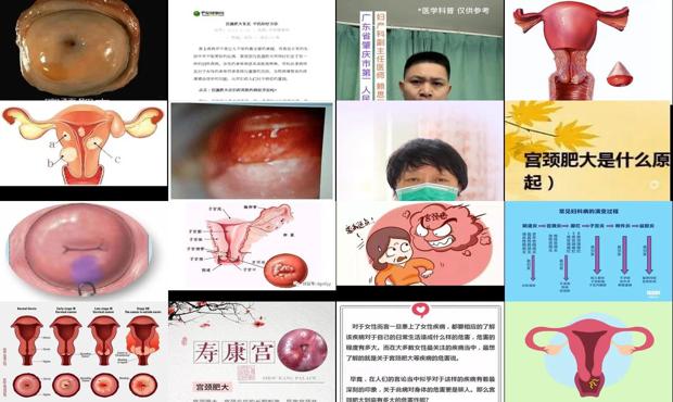 汕头宫颈肥大是怎么回事