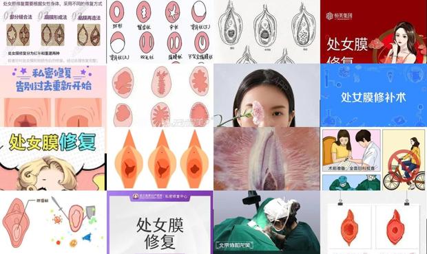 汕头处女膜的修复
