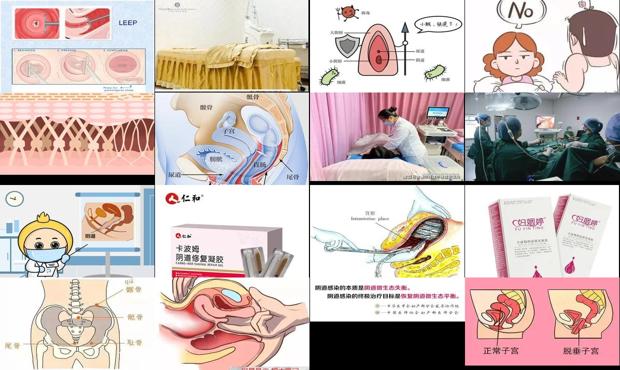 汕头阴道修复
