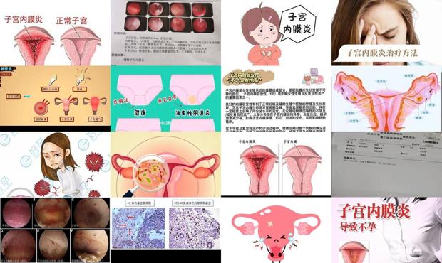 汕头子宫内膜炎性不孕症