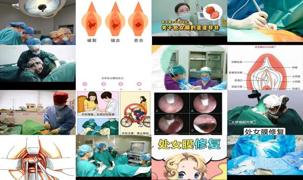 汕头初女模修复手术