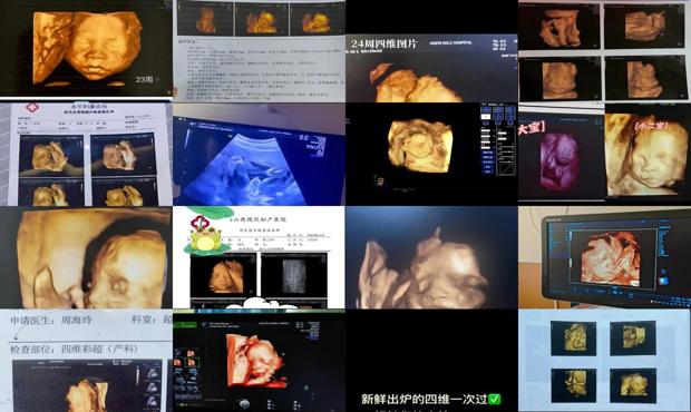 汕头胎儿23周四维彩超