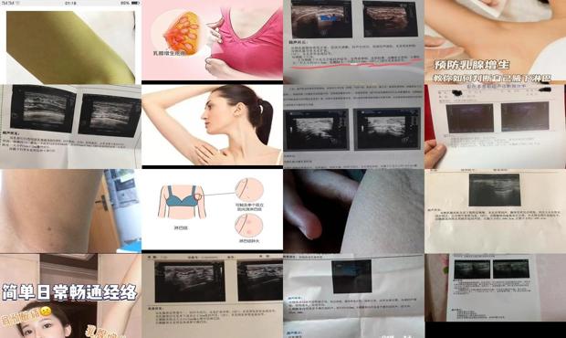 汕头乳腺增生导致的腋下淋巴可以消除的吗