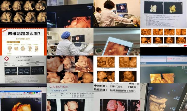 汕头孕妇四维是查什么