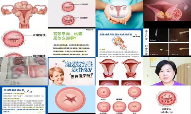 汕头宫颈纳囊需要治疗吗