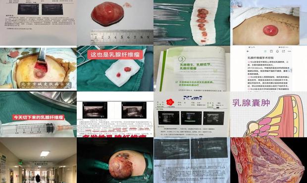汕头乳腺纤维*女的可以娶吗