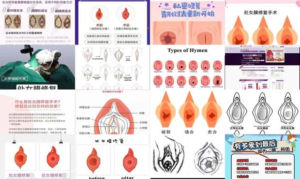 汕头怎么修复处女膜
