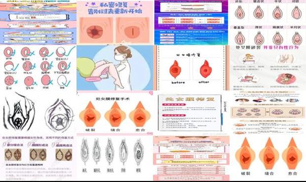 汕头修复处女膜*