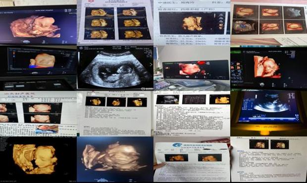 汕头怀孕4个月四维彩超
