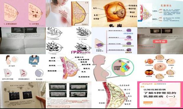 汕头什么原因引起双侧乳腺小叶增生