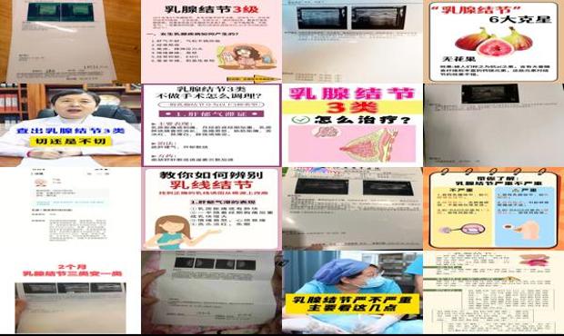 汕头左侧乳腺3类