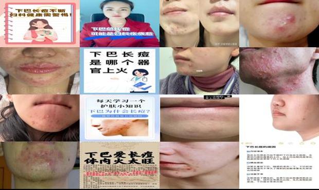 汕头下巴长痘是妇科炎症吗